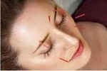 Image of acupuncture needles inserted into a woman's face