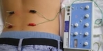 Image of electroacupuncture current applied to needles placed in the lower back  