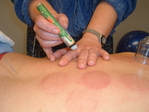 Image of acupuncturist administering moxibustion to points on a patients back 