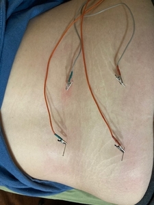 Image of electroacupuncture treatment on the low back