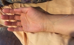 Image of acupuncture needle place in a point on the wrist 