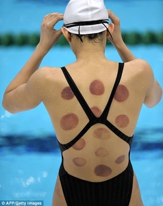 Image of cupping marks on an Olympic swimmer