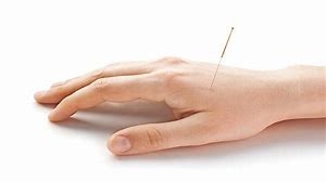 Image of acupuncture needle in place at LI 4 point on the hand 