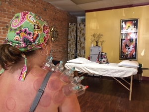 Image of patient receiving cupping on the shoulder
